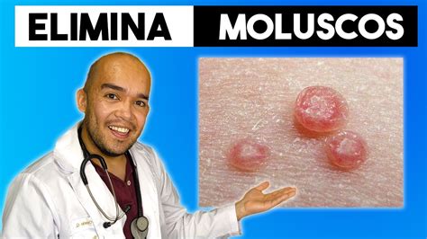 como eliminar molusco contagioso naturalmente|como eliminar molusco contagioso naturalmente